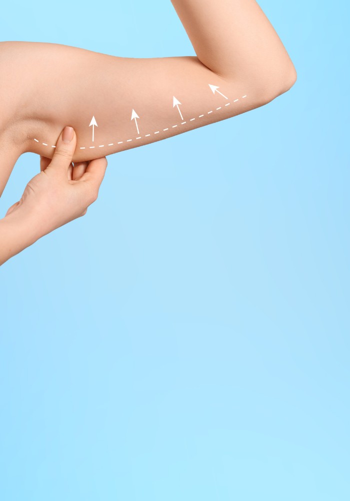 Arm Lift (Brachioplasty)