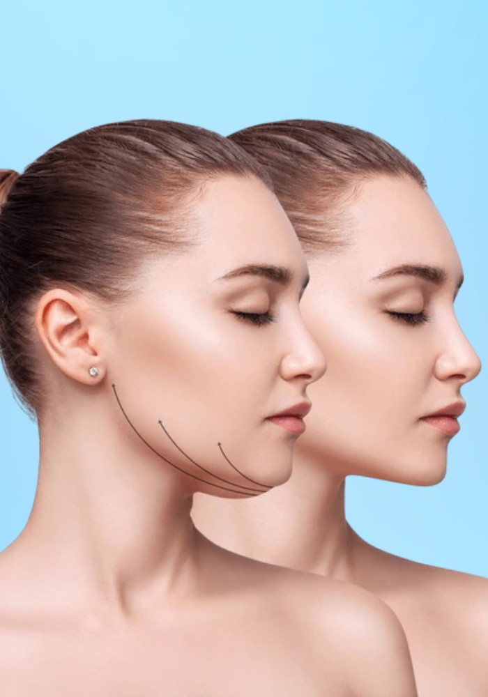 Chin Liposuction
