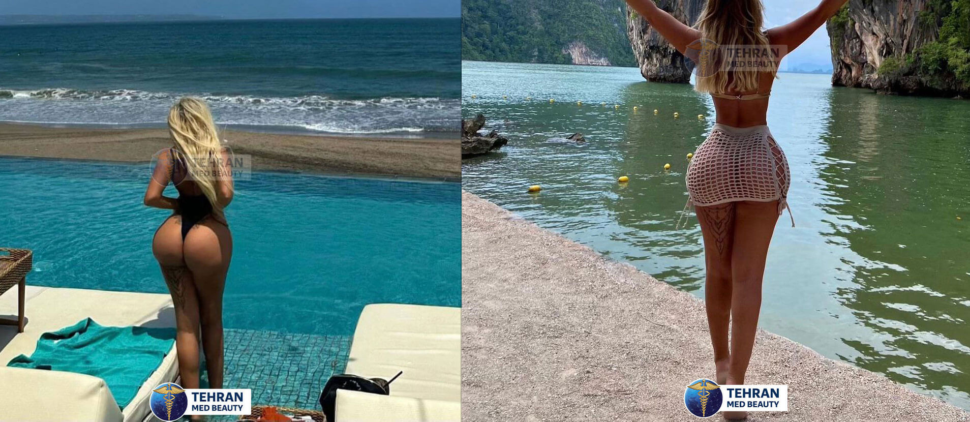Lipo 360 patient result 4 years after surgery in Turkey showing waist contour improvement