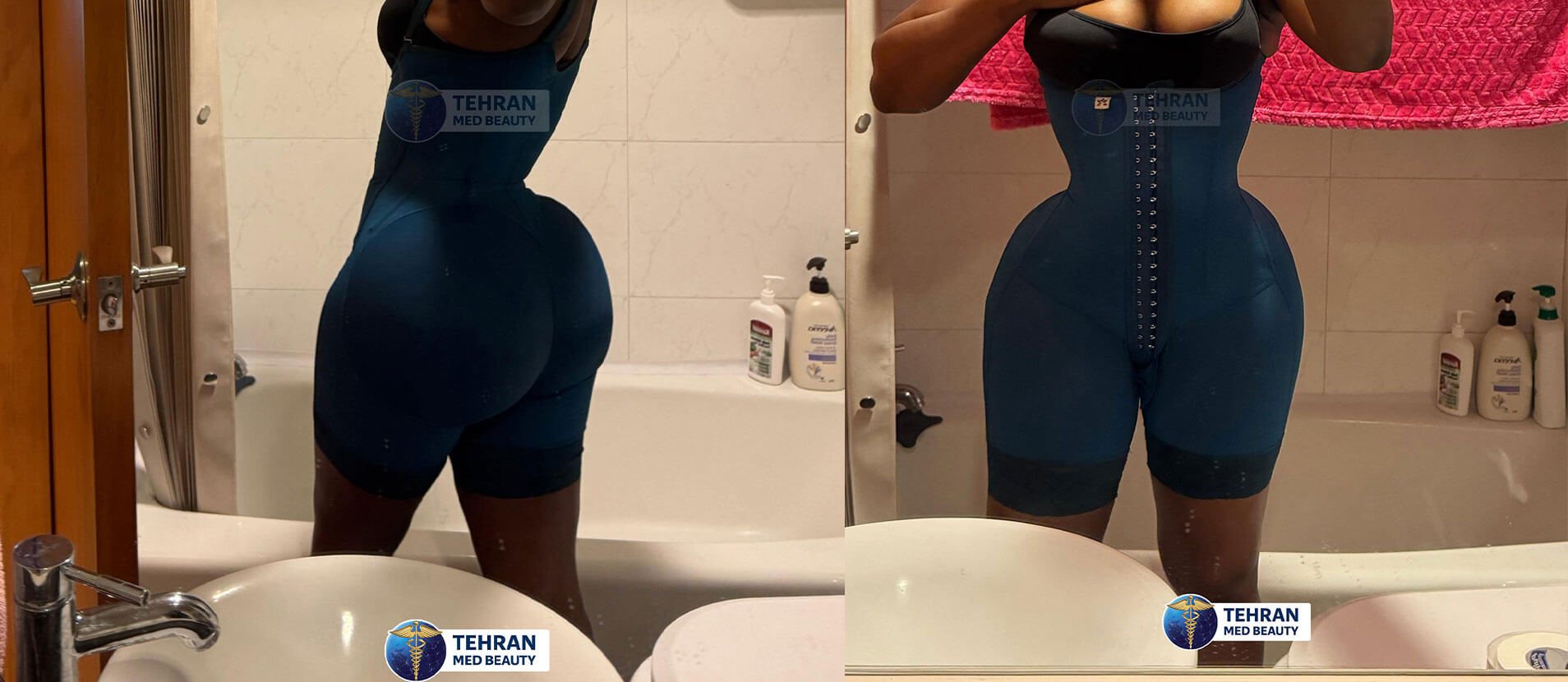 Six-month Lipo 360 recovery result with visible body contouring outcome